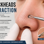 Blackheads Extraction: 10 Safe and Effective Ways to Remove Stubborn Blackheads
