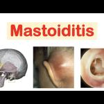 Mastoid Effusion Explained: Causes, Symptoms, and Treatment Options