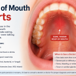 Roof of Mouth Hurts: 10 Common Causes and the Best Treatment Options