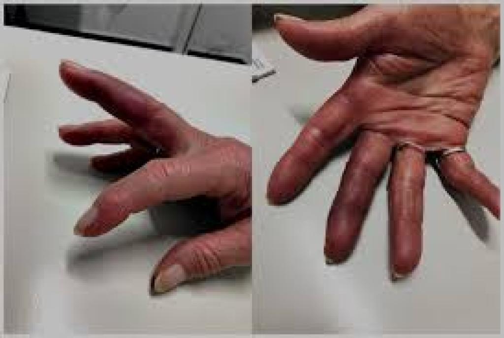 Smashed Finger Swelling and Purple: Signs of Injury, Healing Stages, and Care